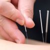 Picture of Acupuncture